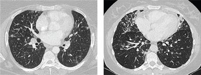 Analysis of Granulomatous Lymphocytic Interstitial Lung Disease Using Two Scoring Systems for Computed Tomography Scans—A Retrospective Cohort Study